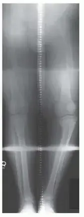 صورة توضيحية لـ مرض بلونت: تقوس الساقين عند الأطفال والكبار - الأسباب، الأعراض، والعلاج مع الدكتور هطيف