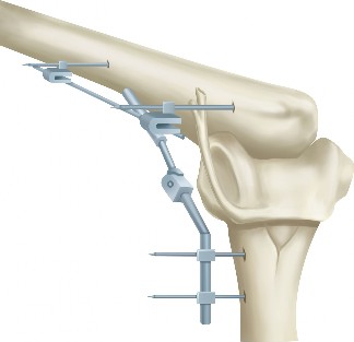 Illustration 33 for Master Diagnosis: Shoulder & Elbow Cases (Reproduced with Permission)