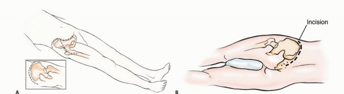 توضيح طبي: جراحة نقائل الحوض: حل شامل لآلام العظام واستعادة الحركة مع الأستاذ الدكتور محمد هطيف