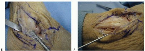 Illustration 13 for Lateral Ankle Repair: Maximize Stability with Interference Screw Fixation