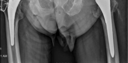 Illustration 9 for Acetabular Revision: Solving Challenges Post Two-Stage Arthroplasty