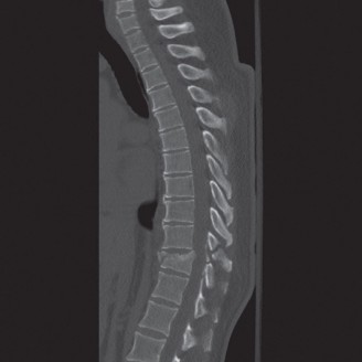 Illustration 37 for Adjacent Segment Degeneration: Your Next Spine Case Solved