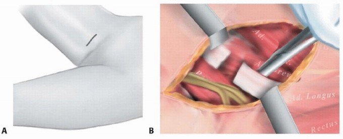 Treat Spastic Hip Disease: Hamstring & Adductor Lengthening