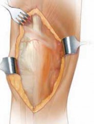 Revision TKA: Master Challenging Exposure with V-Y Quadroplasty