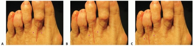 Illustration 12 for Plantar Plate Repair: End Lesser Toe Pain & Instability