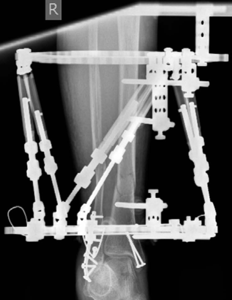 Illustration 3 for Tackle a Complex Lower Limb Trauma Examination Question