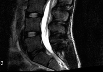 Illustration 22 for Adjacent Segment Degeneration: Your Next Spine Case Solved