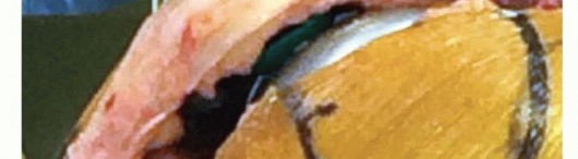 Illustration 39 for Achieve Lasting Pain Relief with Cemented Total Knee Arthroplasty