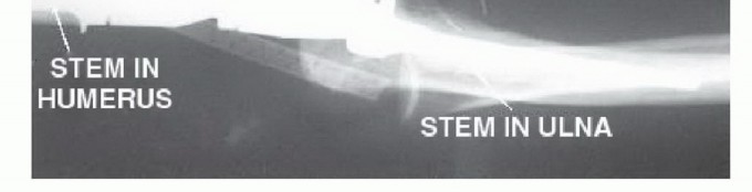 صورة طبية: استئصال الجزء البعيد من عظم العضد: تقنيات آمنة للحفاظ على الطرف في صنعاء مع الأستاذ الدكتور محمد هطيف