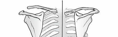 Illustration of scapulothoracic dissociation scapulothoracic - Dr. Mohammed Hutaif