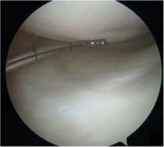 Illustration 5 for Pediatric OCD: When to Consider Drilling for the Femoral