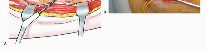 صورة طبية: استئصال أورام الشظية: دليل شامل للعلاج الحديث والحفاظ على الأطراف مع الأستاذ الدكتور محمد هطيف