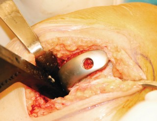 Illustration 68 for Unicompartmental Knee Arthroplasty: Master decisions with this b c figure guide.