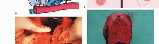 Illustration 28 for Total En Bloc Spondylectomy: Complete Resection for Spinal Tumors