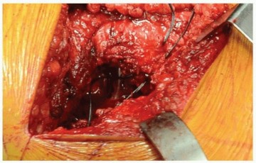 Illustration 5 for Total Hip Arthroplasty: Posterolateral Approach, Extensile & Minimally Invasive