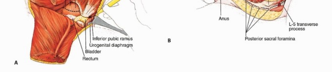 صورة طبية: استئصال نصف الحوض بالرفرفة الأمامية: حلول متقدمة لأورام الحوض الصعبة مع الأستاذ الدكتور محمد هطيف في صنعاء