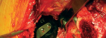 صورة طبية: طول عمر مكون الحُق الأسمنتي في مفصل الورك: مفتاح الاستقرار والديمومة مع الأستاذ الدكتور محمد هطيف في صنعاء