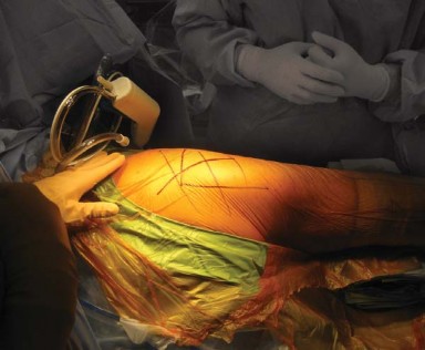 Illustration 3 for Posterolateral Surgical Approaches: Achieve Optimal Hip Replacement