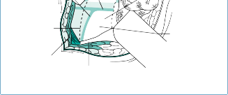Illustration 35 for Mastering Thoracolumbar Surgery: Full Operative Planning