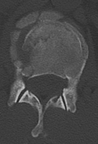 Illustration 10 for Adjacent Segment Degeneration: Your Next Spine Case Solved