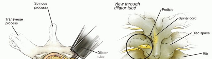 Illustration 3 for Anterior Thoracic Corpectomy: Decompression, Stabilization, Fusion