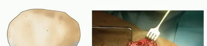 صورة توضيحية لـ تمزق وتر الرضفة: دليل شامل لفهم، علاج، والتعافي مع الأستاذ الدكتور محمد هطيف