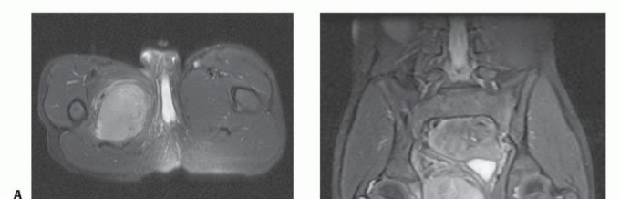 صورة طبية: استئصال أورام العضلات المقربة في الفخذ: الحفاظ على الطرف بتقنيات متقدمة مع الأستاذ الدكتور محمد هطيف في صنعاء