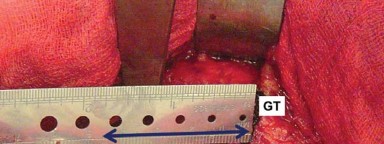 Illustration 10 for Mastering Soft Tissue Balancing for Optimal THR Outcomes