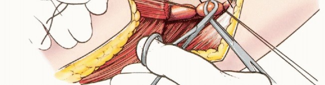 صورة طبية: استئصال نصف الحوض بالرفرفة الأمامية: حلول متقدمة لأورام الحوض الصعبة مع الأستاذ الدكتور محمد هطيف في صنعاء