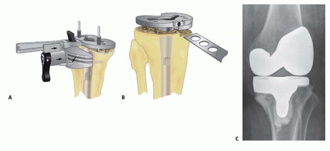 Tibial Bone Loss in TKA Revision: Augments for Complex Cases