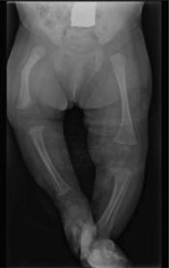 Unraveling Pediatric Orthopaedic Cases: Case 24 Diagnosis