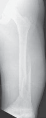 Achieve Optimal Results: Femoral Shaft Reduction & External Fixation