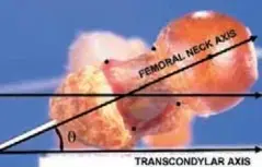 صورة توضيحية لـ تصحيح دوران عظم الفخذ (القدم للداخل): دليل المريض الشامل من الدكتور محمد هطيف