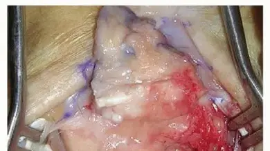 صورة توضيحية لـ استئصال الصف القريب من عظام الرسغ: حل دائم لآلام المعصم المزمنة في اليمن والخليج