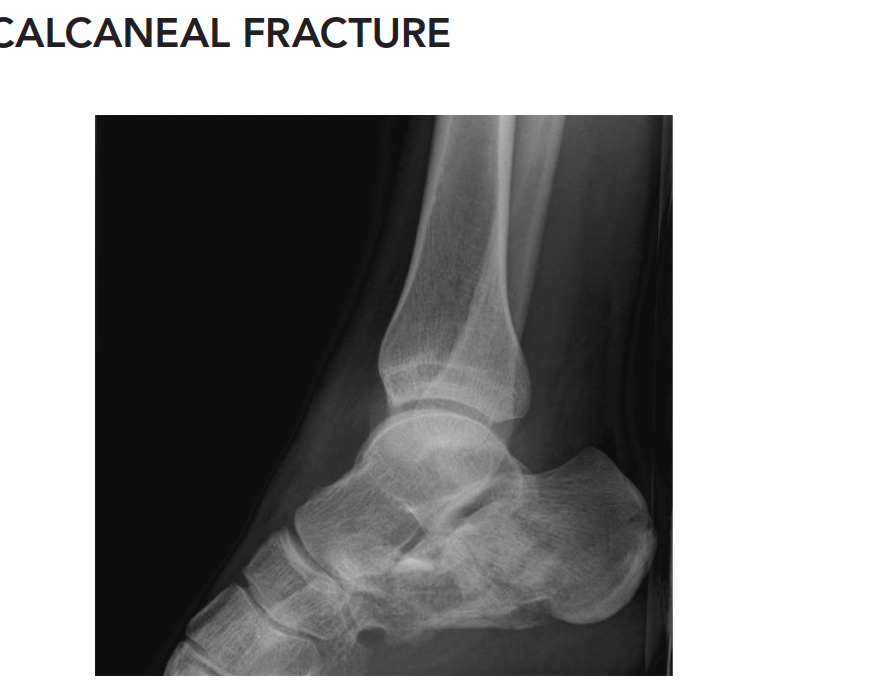 Illustration of case calcaneal fracture - Dr. Mohammed Hutaif