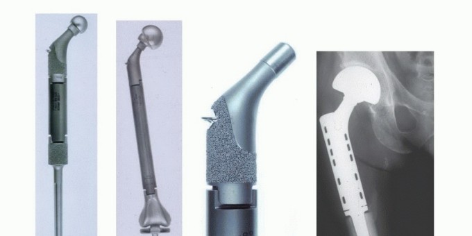 Beyond Amputation: Total Femur Resection with Endoprosthetics