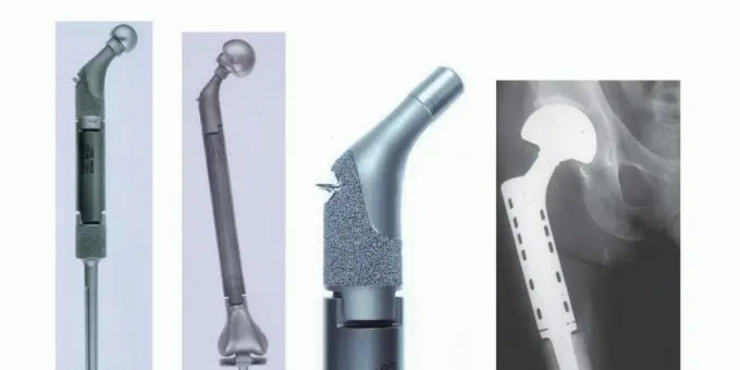 صورة توضيحية لـ استئصال عظم الفخذ الكلي والقريب مع الأطراف الصناعية الداخلية: أمل جديد بعد البتر