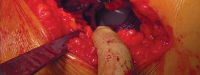 صورة طبية: تقنية الجذع القصير لاستبدال مفصل الورك الكلي: نهج الأستاذ الدكتور محمد هطيف لتدخل جراحي أقل ونتائج أفضل