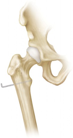 Illustration 8 for Intertrochanteric Femoral Osteotomy: Indications for Hip Preservation