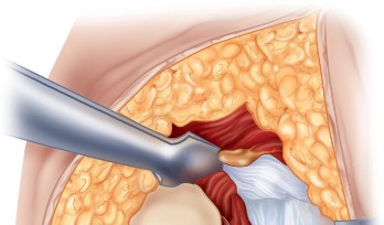 Illustration 4 for Unlock the Figure Posterior Approach to the Hip