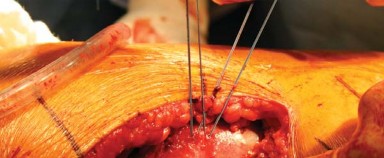 Illustration 33 for Approaches Posterolateral Surgical: A Guide to Enhanced Hip Surgery