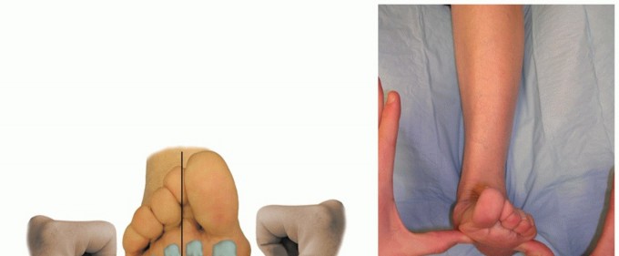 Effectively Treat Forefoot Varus Deformity: Medial Cuneiform Osteotomy