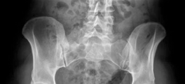 Open Hip Dislocation: How Fascia Lata Autograft Restores Stability