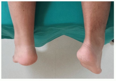 Decoding Mini-Open Repair for Achilles Tendon Ruptures