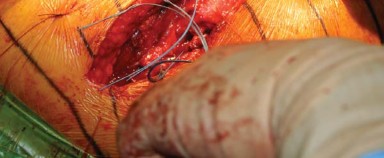 Illustration 32 for Posterolateral Surgical Approaches: Achieve Optimal Hip Replacement