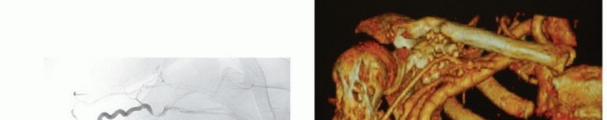 صورة طبية: استئصال أورام الكتف مع الحفاظ على الطرف: أحدث التقنيات لنتائج مثالية مع الأستاذ الدكتور محمد هطيف