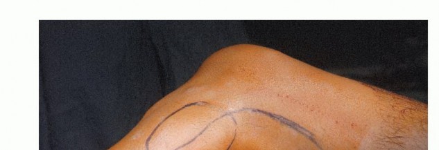 صورة رنين مغناطيسي لورم في الشظية