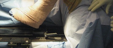 Illustration 11 for Posterior Stabilized Technique: Essential Insights for TKA Success