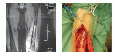 صورة توضيحية لـ الأطراف الصناعية القابلة للتمدد للأطفال: دليل شامل للمرضى حول الوقاية من العدوى والعلاج في صنعاء مع الأستاذ الدكتور محمد هطيف