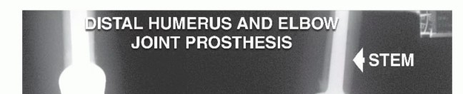 Distal Humeral Resection: Safe Techniques for Limb Preservation